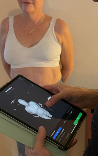 Mastectomy model being scanned by Boost 3D scanning technology