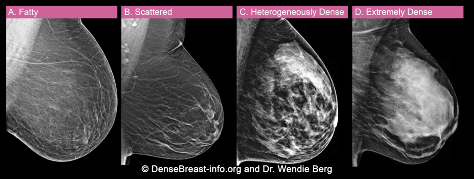 An image detailing x-rays of breasts with varying degrees of breast density.